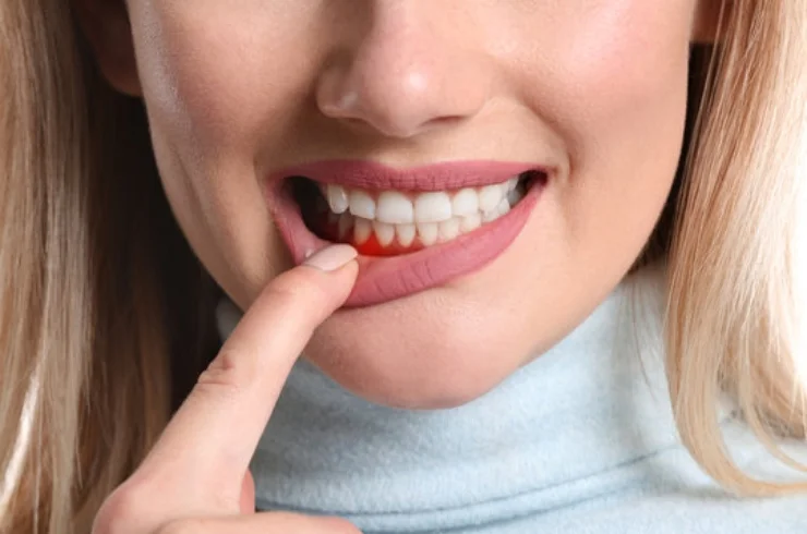 Gum Disease Treatment-----0