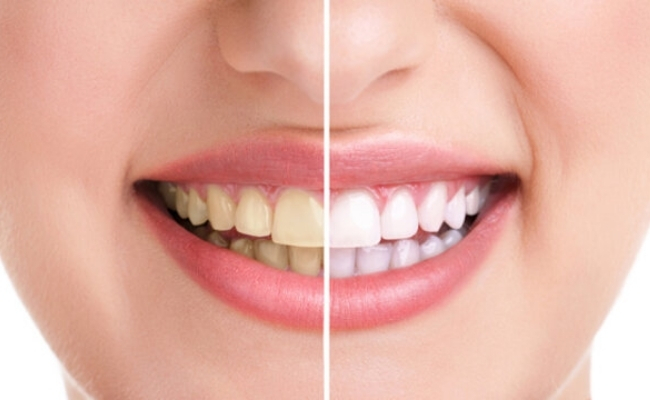 Teeth Whitening