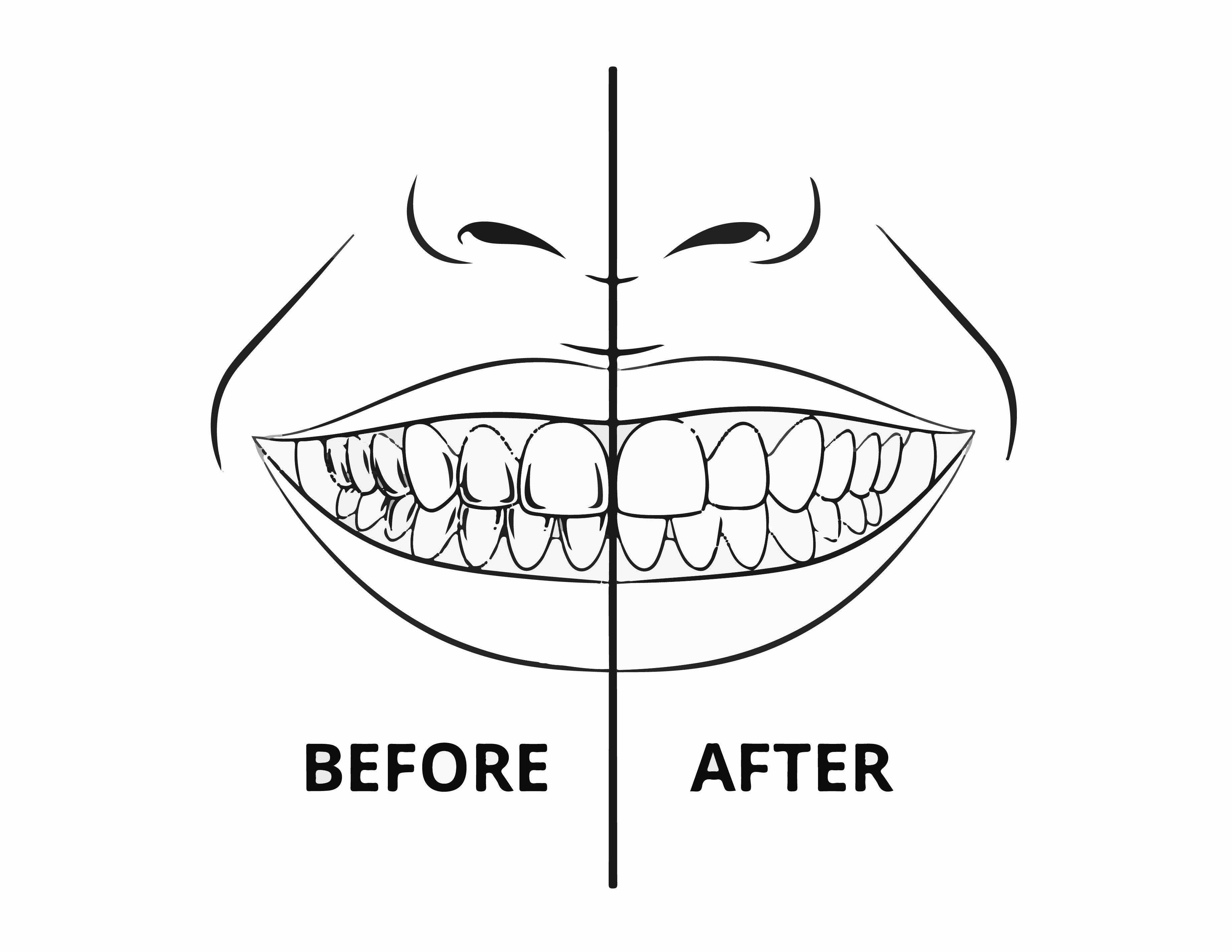 smile makeover