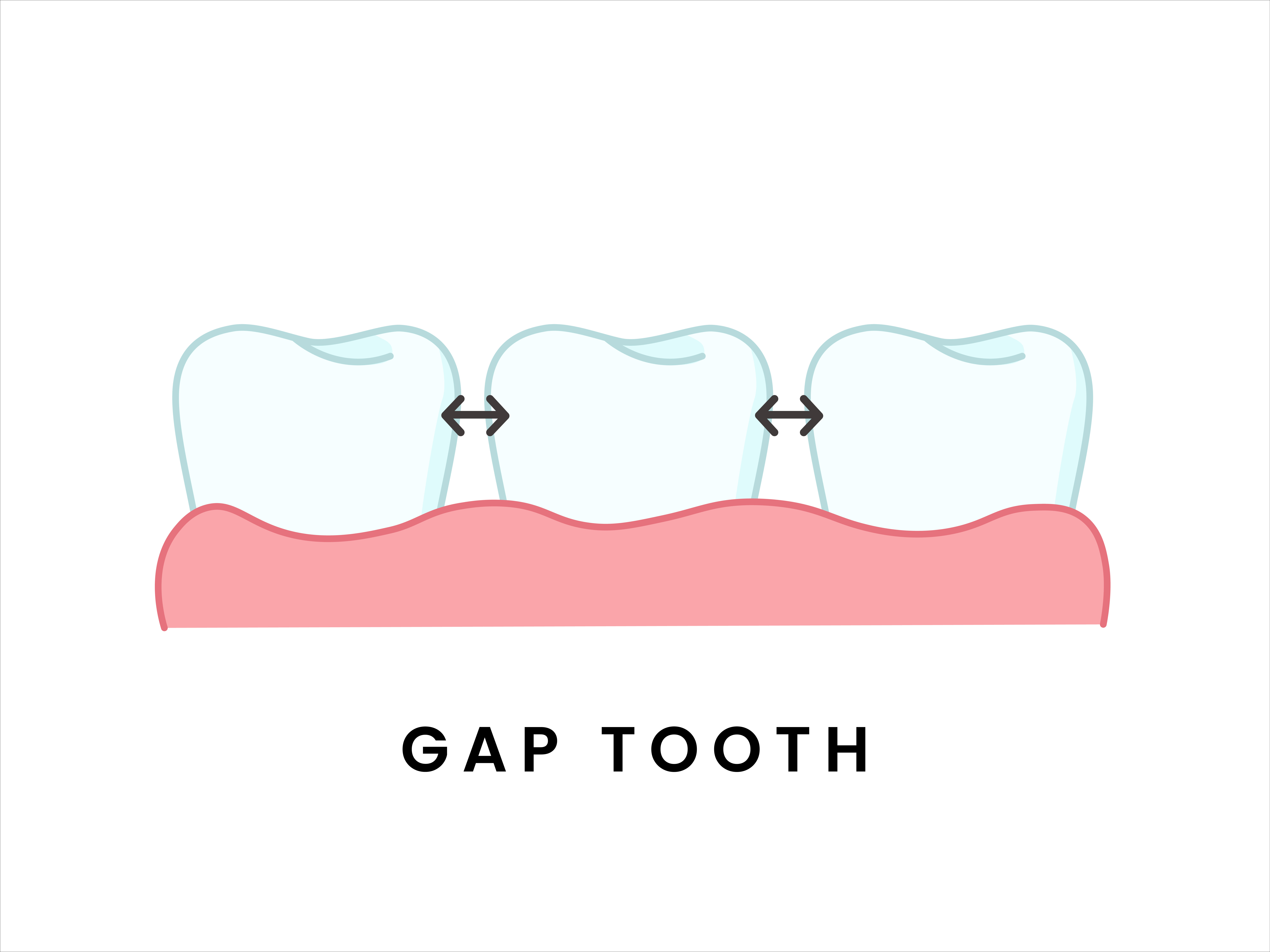 teeth gap treatment