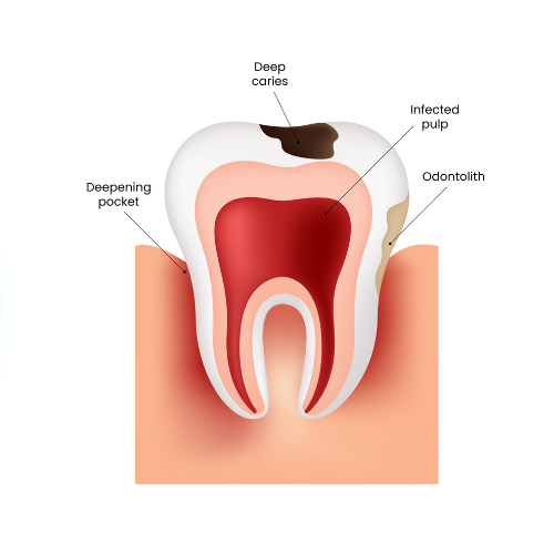 dental filling